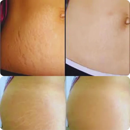 CREMA ANTIESTRÍAS SKINREPAIR